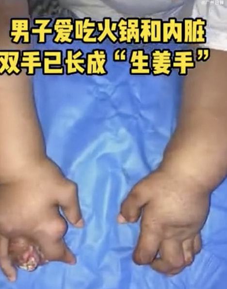 男子爱吃火锅双手痛风似生姜 痛风到底有多可怕?